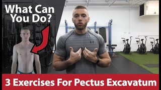 Pectus Excavatum Surgery What Should I Expect After Surgery [upl. by Pfosi]