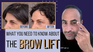 What You Need To Know About The Brow Lift  Dr Ben Talei Beverly Hills Los Angeles [upl. by Atteloj]