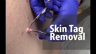 Skin Tag Removal  Dr Derm [upl. by Skier]