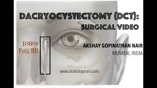 Dacryocystectomy  DCT Lacrimal Mucocele  surgical video Full HD [upl. by Toole89]