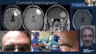 Keyhole Meningioma Removal with Dr Daniel Kelly [upl. by Jillian]