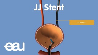 Behandlung von Nieren und Harnleitersteinen JJstent [upl. by Nnylaf]