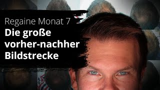 Regaine Monat 7  VorherNachher Vergleich mit Regaine [upl. by Civ]