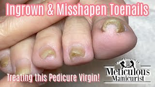 How To Transformation Squeezed Ingrown Toenail Pedicure [upl. by Balthazar]