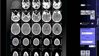 Lumbar spine MRI scan protocols positioning and planning [upl. by Sorel]