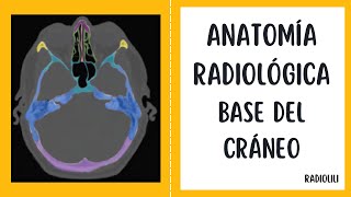 Anatomía Radiológica Base del Cráneo [upl. by Rekcut]