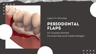 Periodontal Flaps [upl. by Tedra]