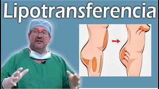 TODO SOBRE la LIPOTRANSFERENCIA 👙 transferencia a GLÚTEOS y MAMAS ❤️ El Dr ALBERTO CALVO RESPONDE [upl. by Sillyhp123]