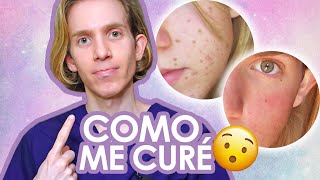 YO SUFRI DE ACNE  Mi experiencia y como me curé  Recomendaciones consejos y mas [upl. by Eelrehpotsirhc835]