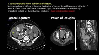 Cases in Radiology Episode 2 abdomen CT [upl. by Gilud]