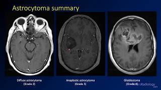 Imaging brain tumors  1  Introduction and classification [upl. by Imeaj]