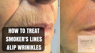 How to Get Rid of Vertical Lip Lines Bye Bye Smoker Lines [upl. by Aikemahs221]