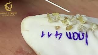 Blackheads and whiteheads extraction 411  Loan Nguyen [upl. by Pik]