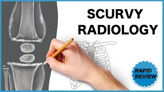 Scurvy Radiological Findings [upl. by Cyrillus]