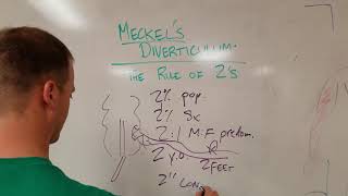 Meckels Diverticulum The Rule of 2s [upl. by Ettennej292]