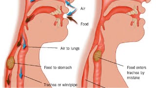 Aspiration Pneumonia [upl. by Radke395]