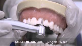 TOOTH PREPARATION FOR AN ALL CERAMIC CROWN [upl. by Wojak]