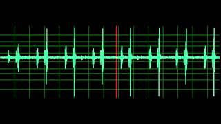 Pulmonary Associated Heart Sounds PAH Split S2 [upl. by Datha634]