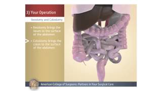 HEMORRHOIDECTOMYSTEP BY STEP OPERATIVE SURGERY [upl. by Johnna]