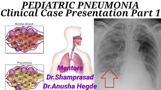 PEDIATRIC PNEUMONIA Part 1 Clinical Case Presentation [upl. by Tnecnev]