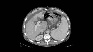 Transjugular Intrahepatic Portosystemic Shunt TIPS [upl. by Eiramnna]