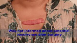 Chest Keloids  Mistakes to Avoid [upl. by Brock]