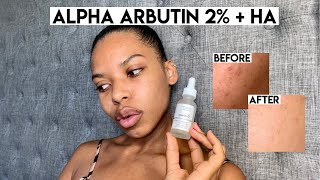 The Ordinarys Alpha Arbutin 2  HA Review  Fade Dark Spots Fast [upl. by Avehsile]