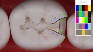 Class II Amalgam 19 MO Acadental  Amalgam Preparation Technique [upl. by Ltihcox]