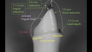 Anterior PFM Preparation  Dr Richard Stevenson [upl. by Maram]