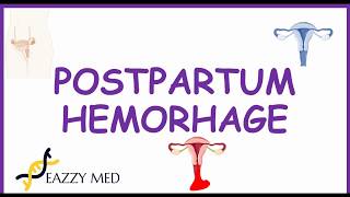 Postpartum Hemorrhage PPH causesrisk factorsprevention and treatment [upl. by Noella]