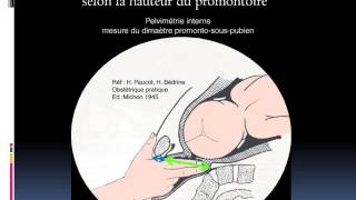 GYNECOLOGIE Examen du bassin obstetrical [upl. by Adnamra783]