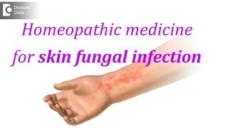 Homeopathic medicine for skin fungal infection  Dr Surekha Tiwari [upl. by Jt]