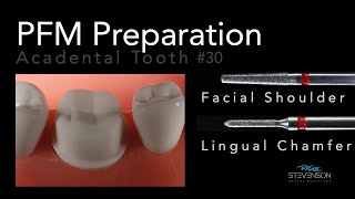 PFM Preparation  Acadental Tooth 30  Dr Richard Stevenson [upl. by Macdonell]