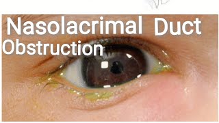 Lacrimal System  Anatomy  Congenital nasolacrimal duct obstruction Part 1 [upl. by Amehr107]