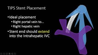 TIPS Stent US Doppler Evaluation [upl. by Cryan562]