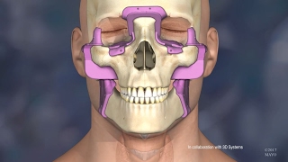 Inside the new firstofitskind double lung transplant technique [upl. by Eissel218]