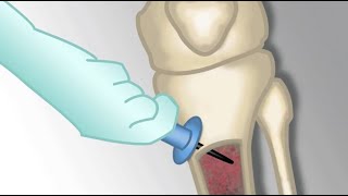 Placement of an Intraosseous Line by MKleinman  OPENPediatrics [upl. by Neirol101]