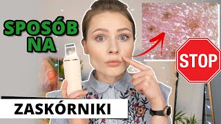 ZASKÓRNIKI  ❌ POZBĄDŹ się ICH ❌ Peeling Kawitacyjny w Domu 🏠 INSTRUKCJA  ZABIEG  EFEKTY 🤩 Pondi [upl. by Ainessej]