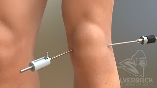 Knee Arthroscopy Animated Video [upl. by Celestia652]