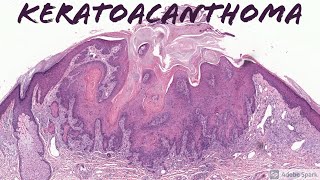 Keratoacanthoma 5Minute Pathology Pearls [upl. by Aniteb]