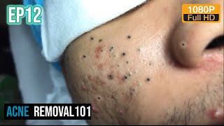 Cystic Acne Extraction 30mn  Blackheads Removal by ACNEREMOVAL101 [upl. by Funk]