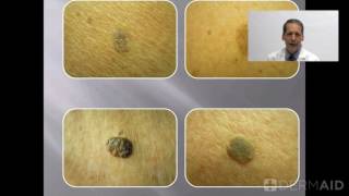 Seborrheic Keratoses [upl. by Enair]