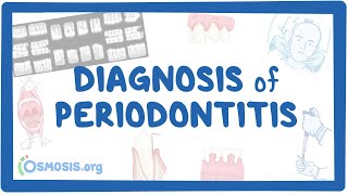 Diagnosis of Periodontitis [upl. by Rhetta385]