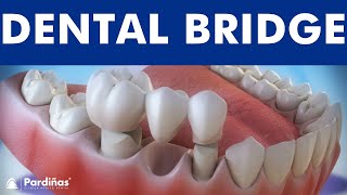 Dental bridge  Fixed dental replacement © [upl. by Hackney]