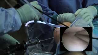 Arthroscopic Knee Surgery Meniscus Tear [upl. by Sofie426]