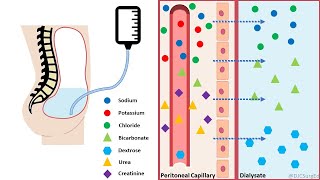 Peritoneal Dialysis [upl. by Schoenburg]