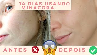 DESAFIO 14 DIAS USANDO MINANCORA ANTES E DEPOIS  Bruna Harmel [upl. by Nitsruk223]