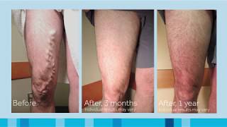 Varicose Vein Treatment  Steves VenaSeal Story [upl. by Armilla]