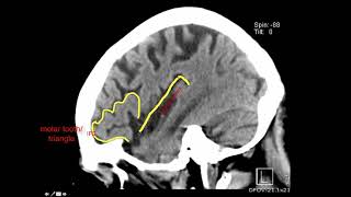 Penelopes Neuroblastoma Cancer Story [upl. by Phyllys851]