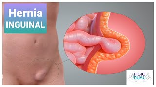 Ejercicios para Hernia Inguinal [upl. by Niarfe]